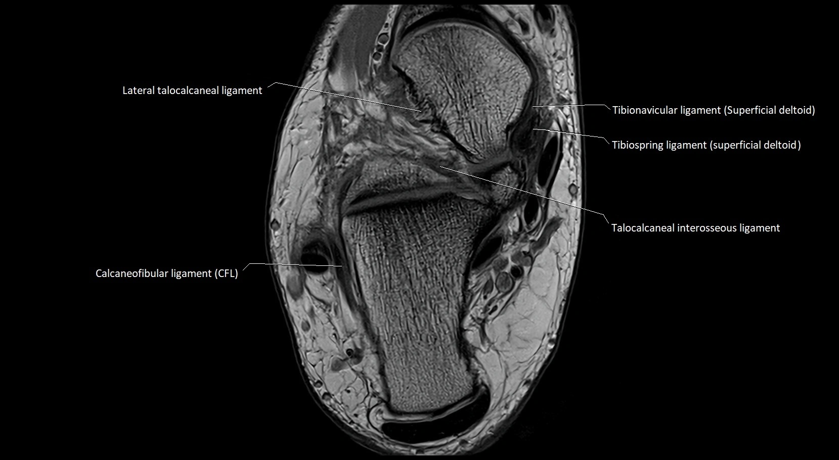 MRI ankle ligaments anatomy axial 3T image 14.webp